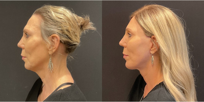 Case 9173 - Woman treated with Facelift, Neck Lift, Chin Implant