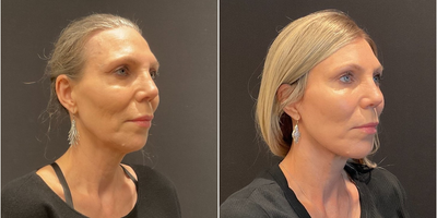 Case 9174 - Woman treated with Facelift, Neck Lift, Chin Implant