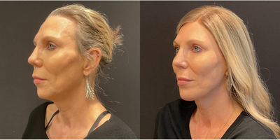 Case 9175 - Woman treated with Facelift, Neck Lift, Chin Implant