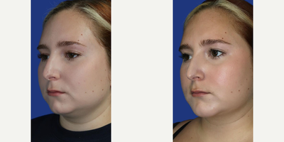 Case 9176 - Woman treated with Chin Implant, Chin Liposuction