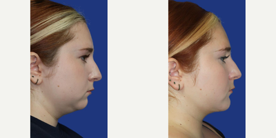 Case 9177 - Woman treated with Chin Implant, Chin Liposuction