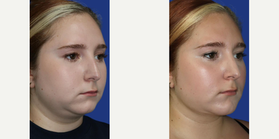 Case 9178 - Woman treated with Chin Implant, Chin Liposuction