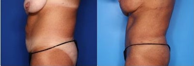 Case 918 - 54 year old woman treated with Tummy Tuck, Liposuction