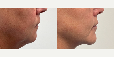 Case 9183 - 45-54 year old woman treated with Chin Implant, Lip Lift