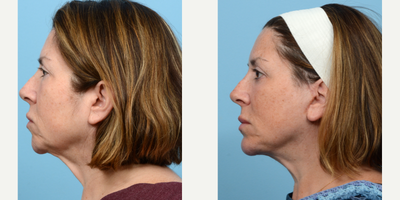 Case 9184 - 45-54 year old woman treated with Chin Implant, Facelift, Deep Plane Facelift, Eyelid Surgery