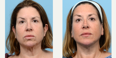 Case 9185 - 45-54 year old woman treated with Chin Implant, Facelift, Deep Plane Facelift, Eyelid Surgery