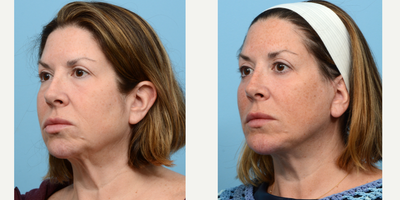 Case 9186 - 45-54 year old woman treated with Chin Implant, Facelift, Deep Plane Facelift, Eyelid Surgery