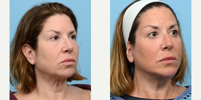 Case 9187 - 45-54 year old woman treated with Chin Implant, Facelift, Deep Plane Facelift, Eyelid Surgery