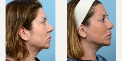 Case 9188 - 45-54 year old woman treated with Chin Implant, Facelift, Deep Plane Facelift, Eyelid Surgery