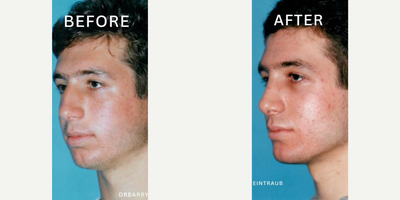 Case 9189 - Man treated with Chin Implant