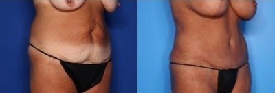 Case 919 - 54 year old woman treated with Tummy Tuck, Liposuction