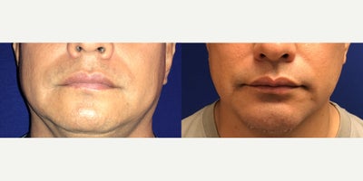 Case 9190 - 45-54 year old man treated with Chin Implant