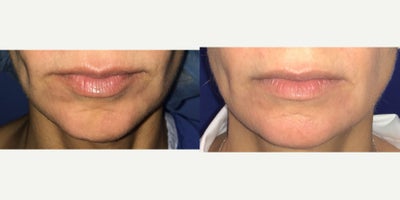 Case 9191 - 45-54 year old woman treated with Chin Implant