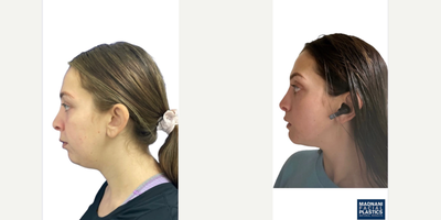 Case 9195 - 25-34 year old woman treated with Chin Implant