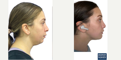 Case 9196 - 25-34 year old woman treated with Chin Implant