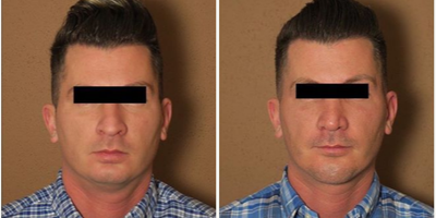 Case 9197 - Man treated with Chin Implant