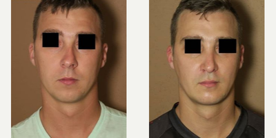 Case 9198 - Man treated with Chin Implant