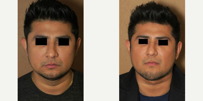 Case 9199 - Man treated with Chin Implant
