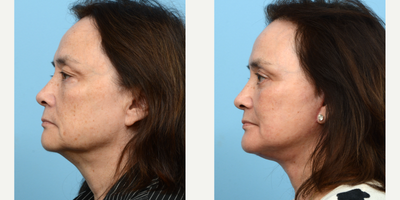 Case 9201 - 55-64 year old woman treated with Chin Implant