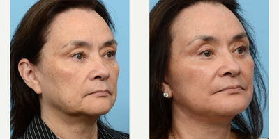 Case 9202 - 55-64 year old woman treated with Chin Implant