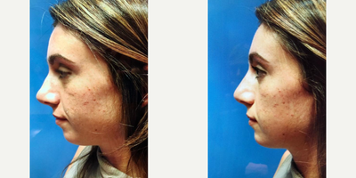 Case 9203 - Woman treated with Chin Implant