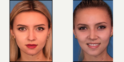 Case 9207 - 25-34 year old woman treated with Chin Implant