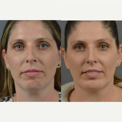 Case 9208 - 35-44 year old woman treated with Chin Implant & Liposuction