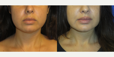 Case 9209 - 32 year old woman treated with Buccal Fat Removal, Lipo, And Chin Implant