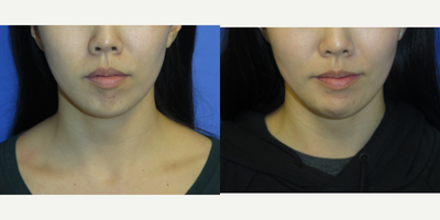 Case 9210 - 34 year old woman treated with Chin Implant