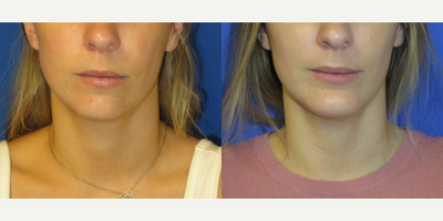 Case 9211 - 26 year old woman treated with Chin Implant