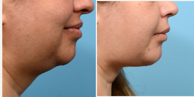 Case 9213 - 25-34 year old woman treated with Chin Implant, Chin Liposuction