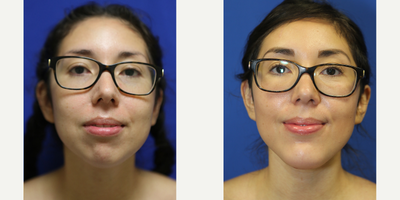 Case 9215 - 25-34 year old woman treated with Chin Implant