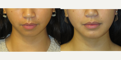 Case 9216 - 24 year old woman treated with Chin Implant