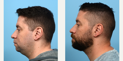Case 9218 - 35-44 year old man treated with Chin Implant, Chin Liposuction