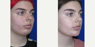 Case 9220 - Woman treated with Chin Implant