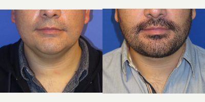 Case 9221 - 32 year old man treated with Chin Implant