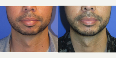 Case 9222 - 34 year old man treated with Chin Implant