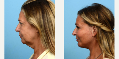 Case 9225 - 45-54 year old woman treated with Neck Lift, Facelift, Lower Facelift, Chin Implant, Facial Fat Transfer