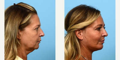 Case 9226 - 45-54 year old woman treated with Neck Lift, Facelift, Lower Facelift, Chin Implant, Facial Fat Transfer