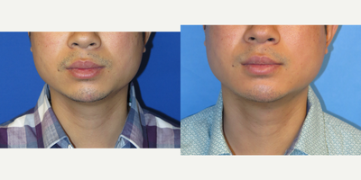 Case 9227 - 33 year old man treated with Chin Implant