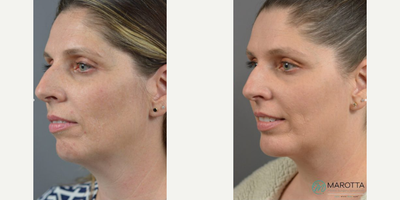 Case 9228 - Woman treated with Chin Implant, Chin Liposuction