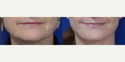 Case: 9229 - before and after photo of Woman treated with Neck Lift, Facelift by Raymond E. Lee, MD