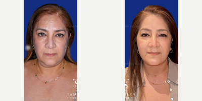 Case: 9230 - before and after photo of Woman treated with Neck Lift by Matthew Tamplen, MD