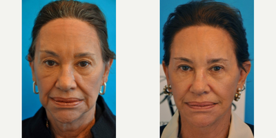 Case: 9232 - before and after photo of Woman treated with Neck Lift by Barry M. Weintraub, MD, FACS