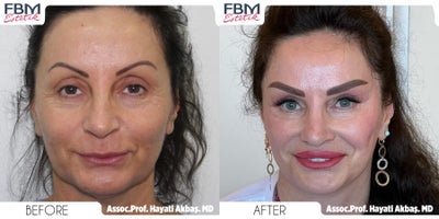 Case: 9233 - before and after photo of 55-64 year old woman treated with Deep Plane Facelift, Neck Lift, Eyelid Surgery, Lip Lift by Hayati Akbas, MD