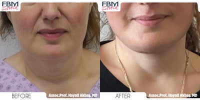 Case: 9235 - before and after photo of 45-54 year old man treated with Neck Lift, Lower Facelift by Hayati Akbas, MD