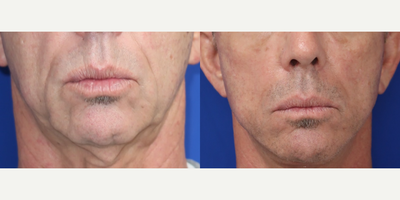 Case: 9237 - before and after photo of 55-64 year old Man treated with Neck Lift by Raymond E. Lee, MD