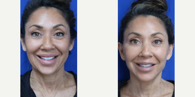 Case 9238 - Woman treated with Facelift, Neck Lift