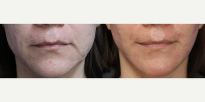 Case 9239 - Woman treated with Facelift, Neck Lift