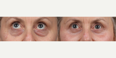 Case 9240 - Woman treated with Deep Plane Facelift, Neck Lift, Eyelid Surgery, Facial Fat Transfer